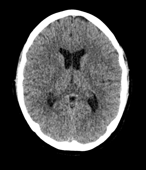 Cerebellar metastases - colorectal adenocarcinoma (Radiopaedia 40947-43652 Axial non-contrast 34).png