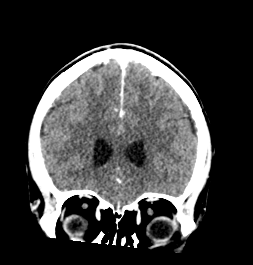 Cerebellar metastases - colorectal adenocarcinoma (Radiopaedia 40947-43652 Coronal C+ 29).png