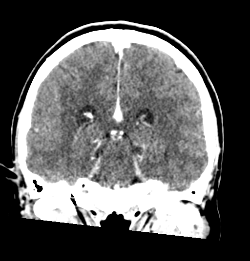 Cerebellar metastases - colorectal adenocarcinoma (Radiopaedia 40947-43652 Coronal C+ 55).png
