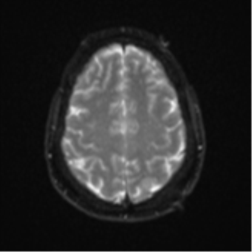 Cerebellar metastasis (Radiopaedia 51137-56765 Axial DWI 22).png