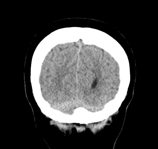 File:Cerebellar metastasis (Radiopaedia 54578-60812 Coronal non-contrast 54).png