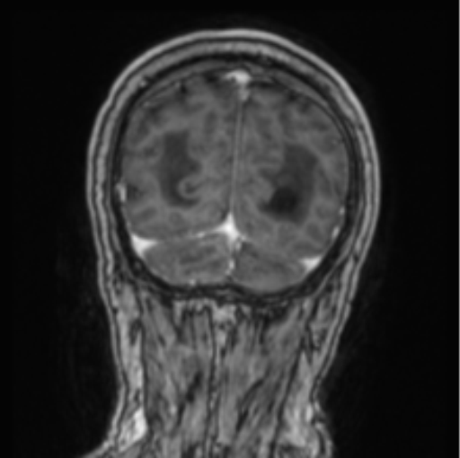 Cerebellar metastasis from lung adenocarcinoma (Radiopaedia 86690-102829 Coronal T1 C+ 19).png