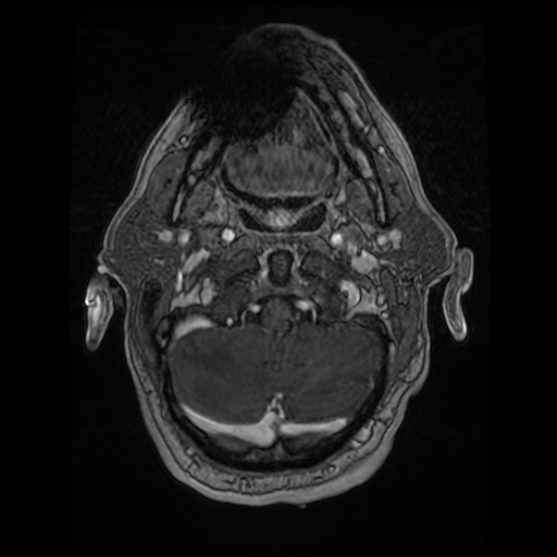 Cerebellar metastasis of pulmonary adenocarcinoma, cavernous venous malformation, and developmental venous anomaly (Radiopaedia 85827-101661 Axial T1 C+ 17).jpg