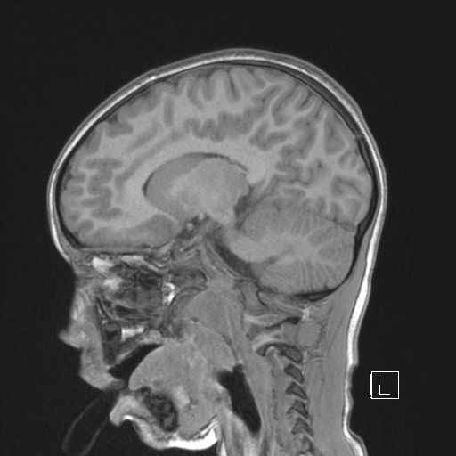 File:Cerebellar stroke (Radiopaedia 32202-33150 Sagittal T1 C+ 31).png