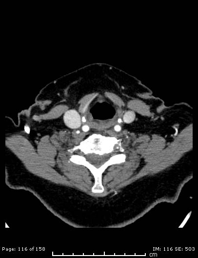 Cerebellar strokes due to intracranial giant cell arteritis (Radiopaedia 68799-78510 CT angiogram 116).jpg