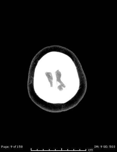 Cerebellar strokes due to intracranial giant cell arteritis (Radiopaedia 68799-78510 CT angiogram 9).jpg