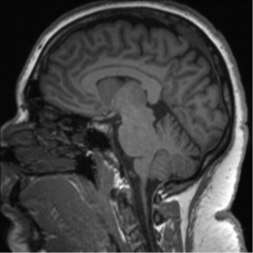 Cerebellopontine angle meningioma (Radiopaedia 48434-53348 Sagittal T1 44).png