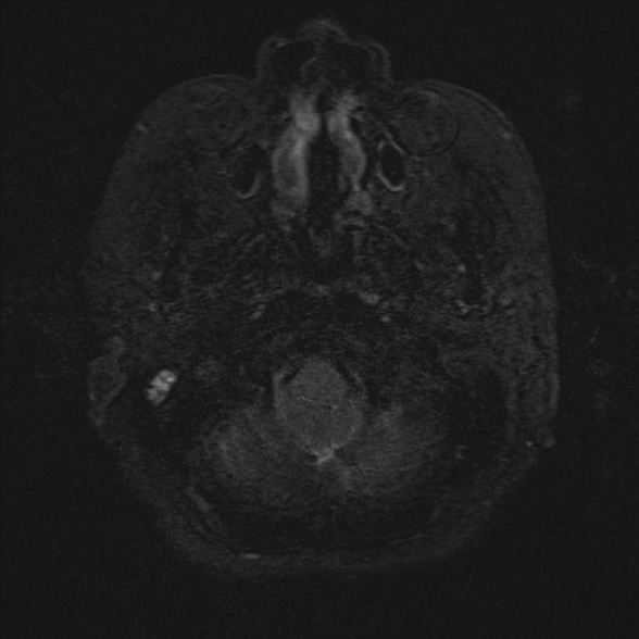 Cerebellopontine angle meningioma (Radiopaedia 53561-59591 Axial 3D volume T2 5).jpg