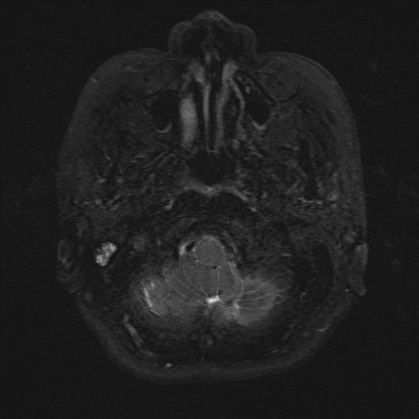 File:Cerebellopontine angle meningioma (Radiopaedia 53561-59591 Axial 3D volume T2 9).jpg