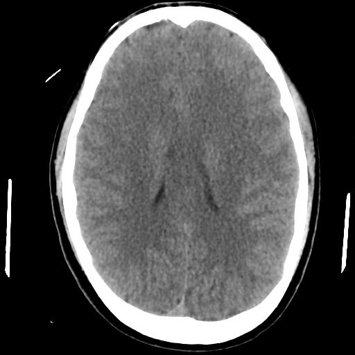 Cerebral abscess (Radiopaedia 29451-29919 Axial non-contrast 30).jpg