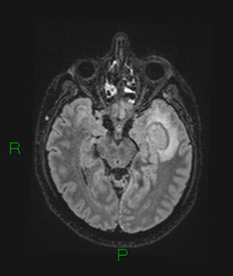 Cerebral abscess and subdural empyema (Radiopaedia 84436-99779 Axial FLAIR 51).jpg