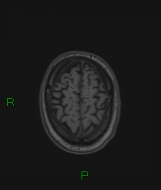 Cerebral abscess and subdural empyema (Radiopaedia 84436-99779 Axial T1 17).jpg