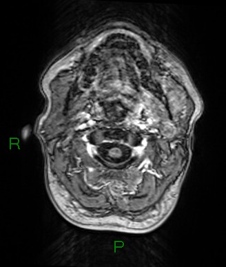 Cerebral abscess and subdural empyema (Radiopaedia 84436-99779 Axial T1 C+ 86).jpg