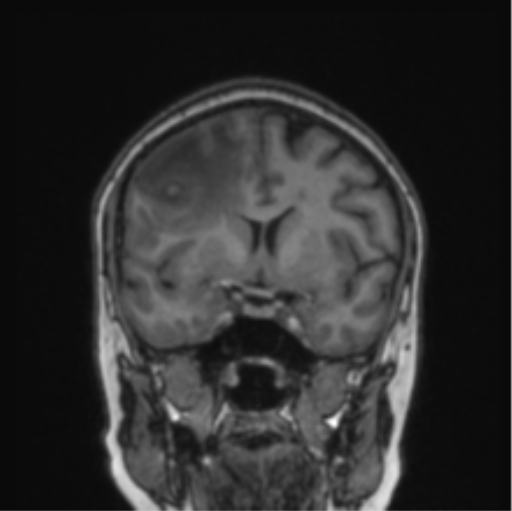 Cerebral abscess from pulmonary arteriovenous malformation (Radiopaedia 86275-102291 Coronal T1 56).png