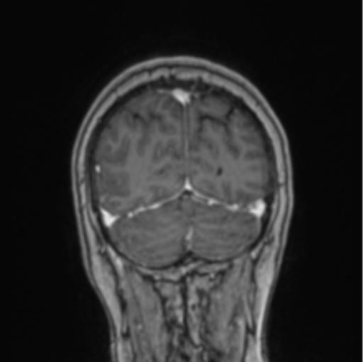 File:Cerebral abscess from pulmonary arteriovenous malformation (Radiopaedia 86275-102291 L 20).png