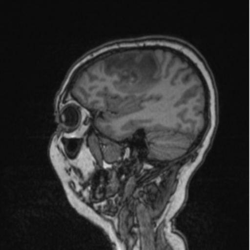 Cerebral abscess from pulmonary arteriovenous malformation (Radiopaedia 86275-102291 Sagittal T1 71).png