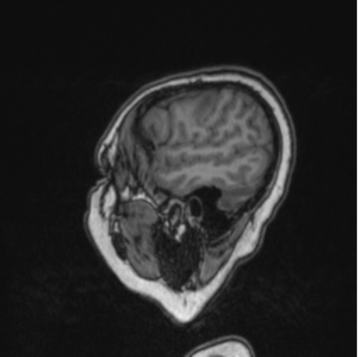 Cerebral abscess from pulmonary arteriovenous malformation (Radiopaedia 86275-102291 Sagittal T1 79).png