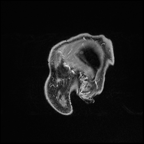 Cerebral abscess with ventriculitis (Radiopaedia 78965-91878 Sagittal T1 C+ 13).jpg
