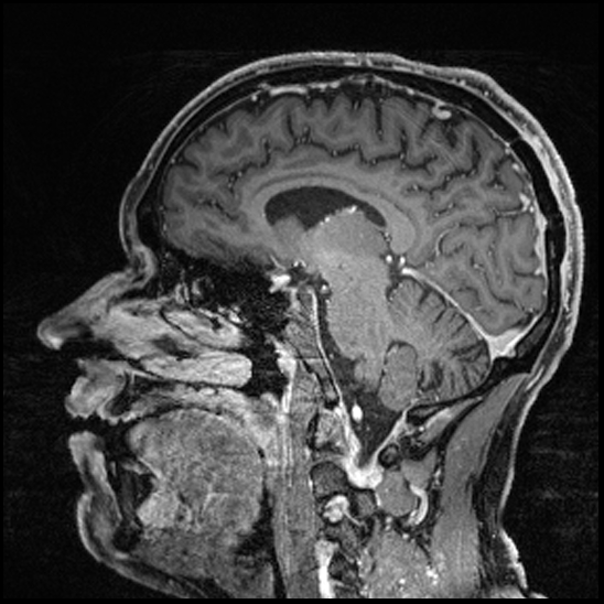 Cerebral abscess with ventriculitis (Radiopaedia 78965-91878 Sagittal T1 C+ 83).jpg