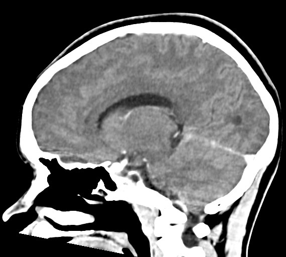 Cerebral abscesses (Radiopaedia 70458-80568 Sagittal Contrast 33).jpg