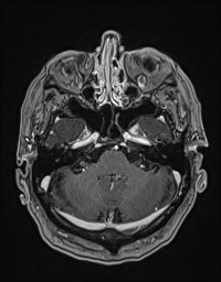 Cerebral amyloid angiopathy-related inflammation (Radiopaedia 58270-65377 Axial T1 C+ fat sat 26).jpg