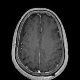 Cerebral amyloid angiopathy (Radiopaedia 29129-29518 Axial T1 C+ 105).jpg