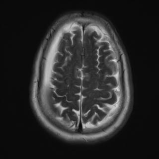 File:Cerebral amyloid angiopathy (Radiopaedia 29129-29518 Axial T2 17).jpg