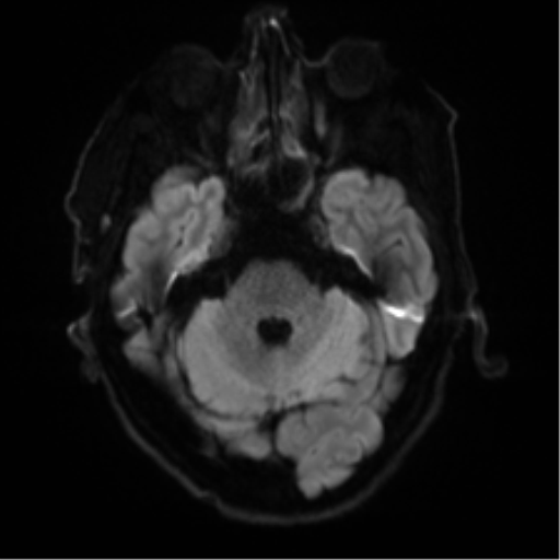 Cerebral amyloid angiopathy (Radiopaedia 46082-50433 Axial DWI 34).png