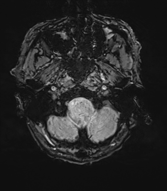 File:Cerebral amyloid angiopathy (Radiopaedia 46082-50433 Axial SWI 8).png