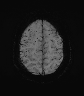 Cerebral amyloid angiopathy (Radiopaedia 46082-50433 Axial SWI MIP 65).png