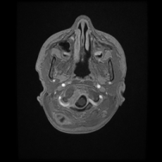 Cerebral and spinal tuberculosis (Radiopaedia 90489-107837 Axial T1 C+ 26).jpg