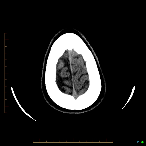 Cerebral arteriovenous malformation (AVM) (Radiopaedia 78162-90706 Axial non-contrast 59).jpg
