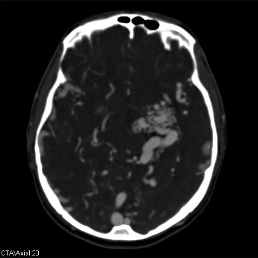 Cerebral arteriovenous malformation (Radiopaedia 28518-28759 B 20).jpg