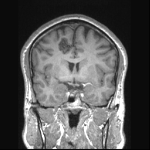 Cerebral arteriovenous malformation (Radiopaedia 39259-41506 Coronal T1 55).png