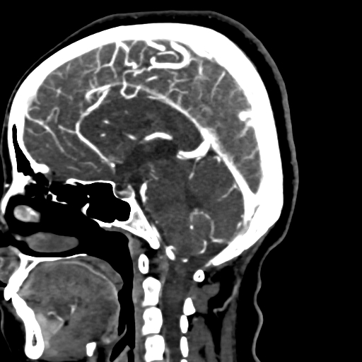 Cerebral arteriovenous malformation (Radiopaedia 73830-84645 Sagittal C+ delayed 44).jpg