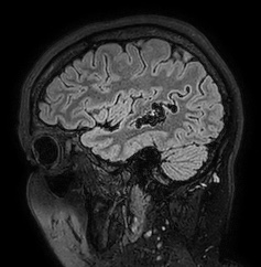 Cerebral arteriovenous malformation (Radiopaedia 74411-85654 Sagittal FLAIR 26).jpg