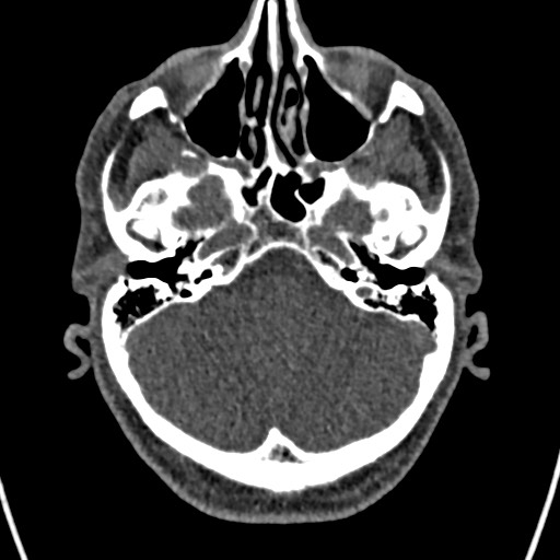 Cerebral arteriovenous malformation (Radiopaedia 78188-90746 Axial non-contrast 38).jpg