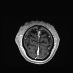 Cerebral arteriovenous malformation (Radiopaedia 84015-99245 Coronal T1 C+ 160).jpg