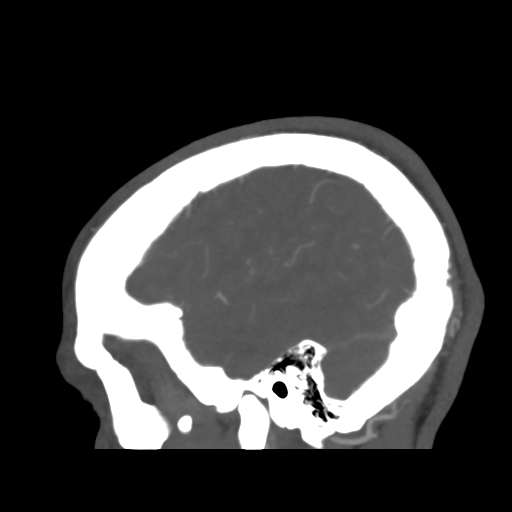 Cerebral arteriovenous malformation (Spetzler-Martin grade 2) (Radiopaedia 41262-44076 G 45).png