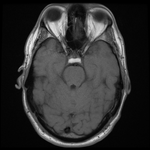 File:Cerebral arteriovenous malformation (Spetzler-Martin grade 2) (Radiopaedia 41262-44092 Axial T1 6).png