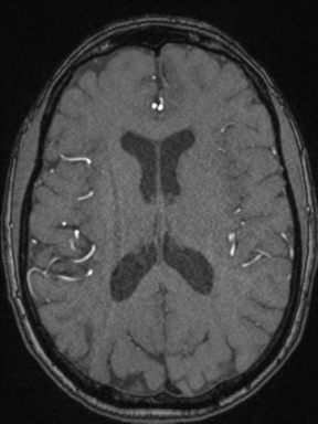 Cerebral arteriovenous malformation with hemorrhage (Radiopaedia 34422-35737 Axial MRA 48).png