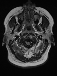File:Cerebral cavernoma and development venous anomaly (Radiopaedia 37603-39482 Axial FLAIR 1).png