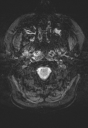 File:Cerebral cavernoma and development venous anomaly (Radiopaedia 37603-39482 Axial SWI 2).png