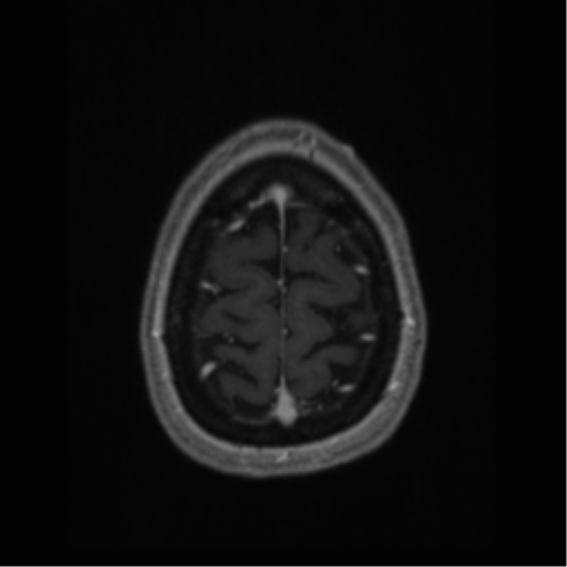 Cerebral cavernoma and development venous anomaly (Radiopaedia 37603-39482 Axial T1 C+ 69).png