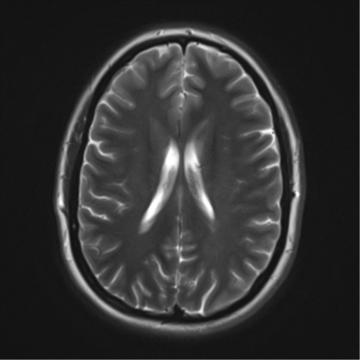 File:Cerebral cavernoma and development venous anomaly (Radiopaedia 37603-39482 Axial T2 14).png