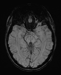 Cerebral cavernous venous malformation (Radiopaedia 70008-80021 Axial SWI 29).jpg