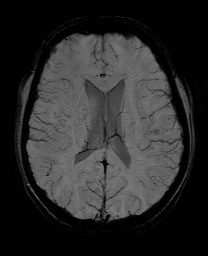 Cerebral cavernous venous malformation (Radiopaedia 70008-80021 Axial SWI 41).jpg