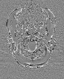 Cerebral cavernous venous malformation (Radiopaedia 70008-80021 G 2).jpg