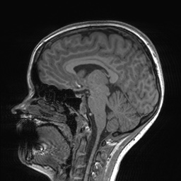 File:Cerebral cavernous venous malformation (Radiopaedia 70008-80021 Sagittal T1 35).jpg