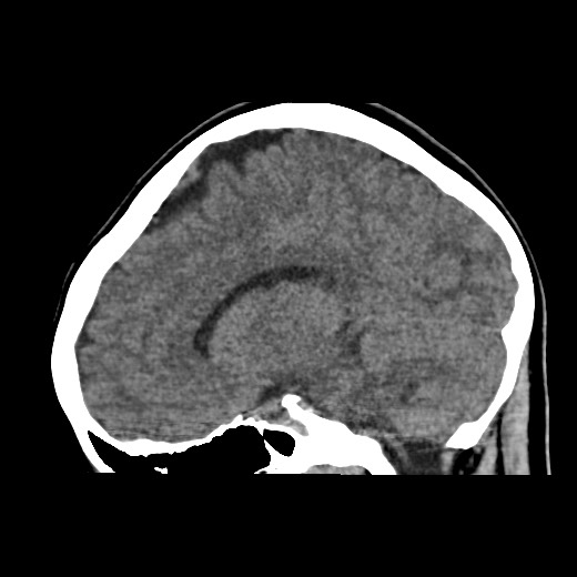 Cerebral cavernous venous malformation (Radiopaedia 70008-80022 C 33).jpg